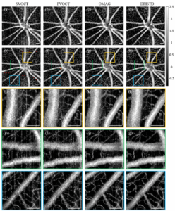 融合差分相位与强度图像提升视网膜OCTA活体成像质量——《Optics Letters》论文